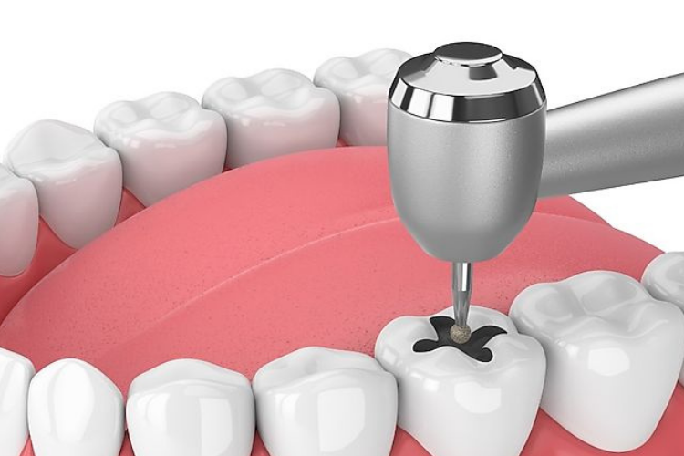Endodontic Surgery Procedure